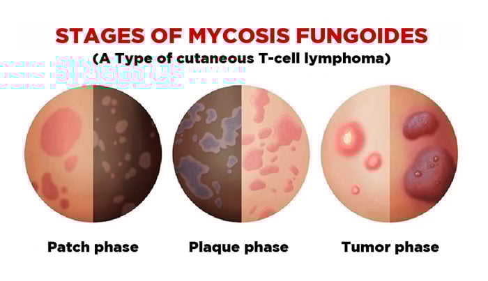 Stages-of-mycosis-fungoides Stages-of-mycosis-fungoides